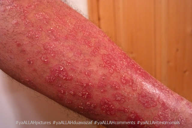 Psoriasis Or Chambal Treatment In Tib E Nabvi In Islam